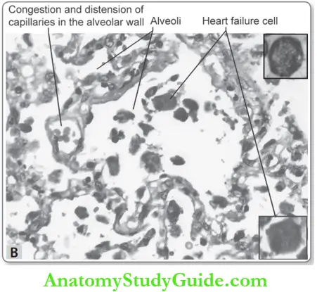Hemodynamic Disorders Chronic Venous Congestion Lung Alveolar Lumen Inset