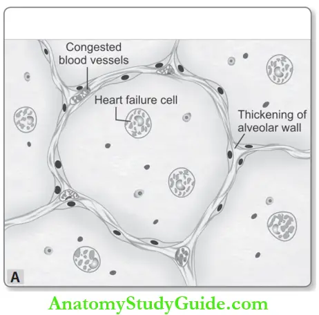 Hemodynamic Disorders Chronic Venous Congestion Lung