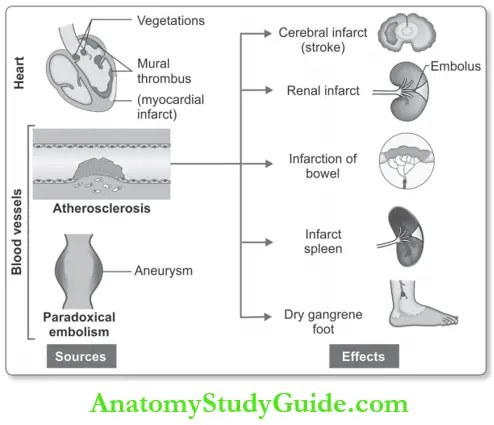 Hemodynamic Disorders Common Sources And Effects Of Systemic Arterial Emboli