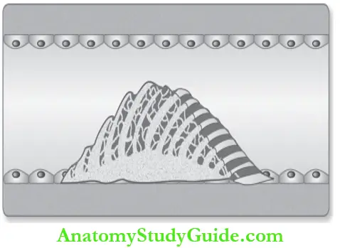 Hemodynamic Disorders Diagrammatic Appearance Of Thrombus Showing Alternating Dark And Light Areas