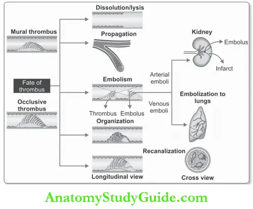 Hemodynamic Disorders Fate Of Thrombus