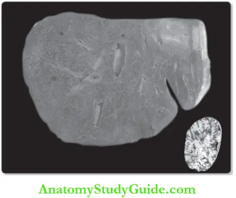 Hemodynamic Disorders Gross Appearance Of Chronic Venous Congestion Of Liver