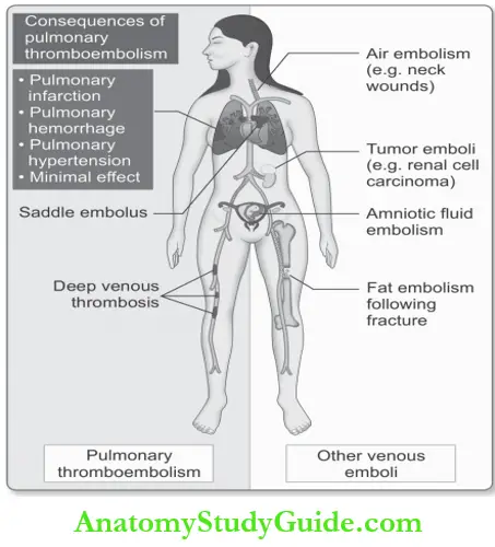 Hemodynamic Disorders Sources And Effcts Of Venous Emboli
