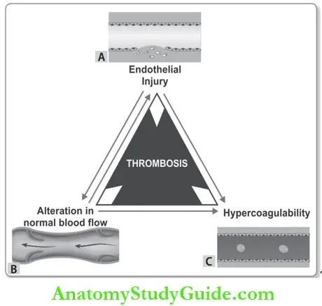 Hemodynamic Disorders Virchow s Triad In Thrombosis