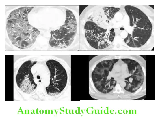 Infectious Diseases Chest CT fidings in COVID-19