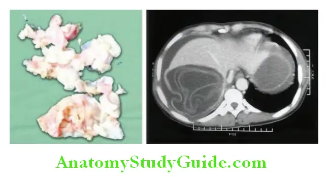 Infectious Diseases Gross appearance of hydatid cyst and hydatid cyst on CT abdomen