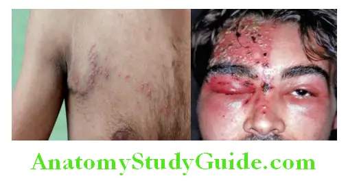 Infectious Diseases Herpes zoster—dermatomal involvement and Ramsay Hunt syndrome