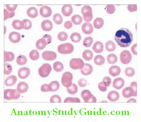 Infectious Diseases Peripheral smear showing ring forms of malaria