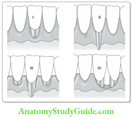 Mucogingival Surgery Classification Of Gingival Recession