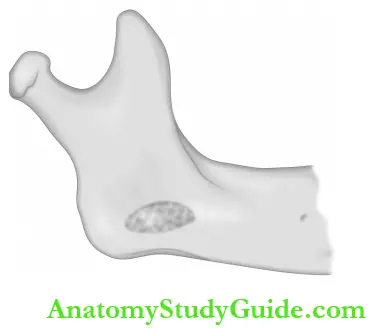 Odontogenic And Nonodontogenic Tumors Ameloblastoma