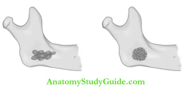 Odontogenic And Nonodontogenic Tumors Soap Bubble ApperanceOf Ameloblastoma, Honeycomb Appearance Of ameloblastoma