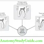 Periodontitis Associated With Endodontic Lesions Endo-perio Lesions