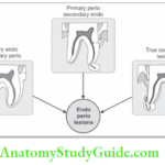 Periodontitis Associated With Endodontic Lesions Endo-perio Lesions