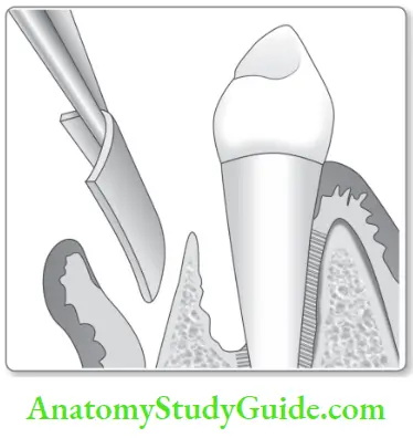 Reconstructive Osseous Surgery Membrance Positioned And Sutured