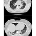 Respiratory System CT sections showing patterns of ILD DPLD