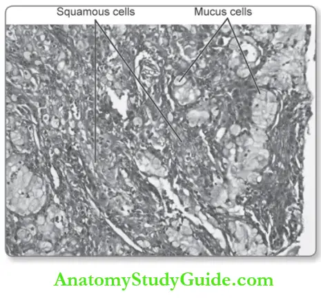 Salivary Glands Mucoepidermoid Carcinoma Composed Of Squamous Cells