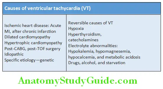 Cardiology Causes of ventricular tachycardia VT