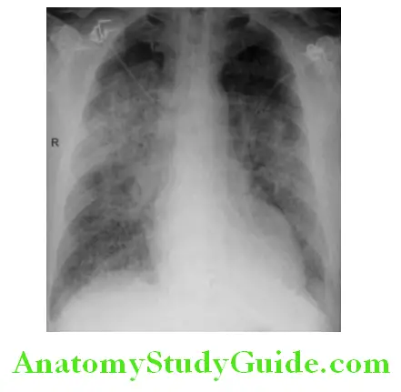 Cardiology Chest X-ray in heart failure showing bat wing appearance
