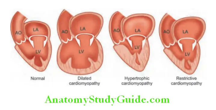 Cardiology Clinical classifiation of cardiomyopathy