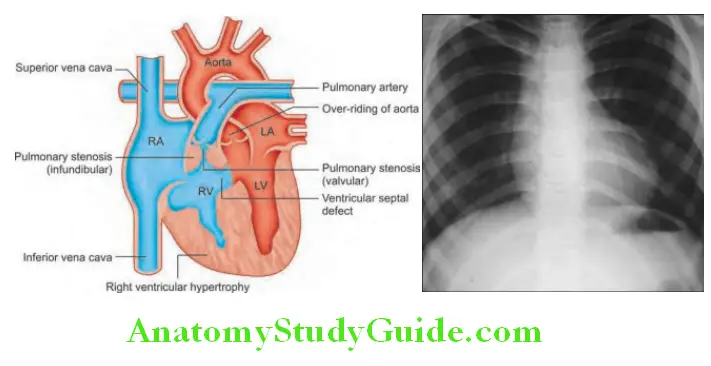 Cardiology Diagrammatic representation of tetralogy of Fallot and X-ray shows an abnormally small pulmonary artery, large right ventricle and a ‘boot-shaped’ heart