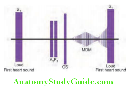 Cardiology Diagrammatic representation of timing of heart sounds and murmur in mitral stenosis features are loud fist heart sound, an opening snap OS