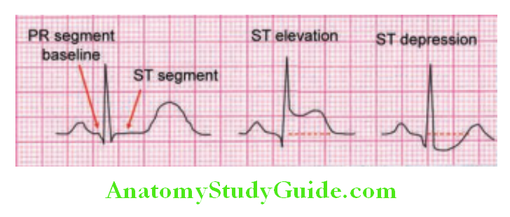 Cardiology ECG showing ST-segment elevation