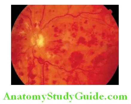Cardiology Fundus image of hypertensive retinopathy