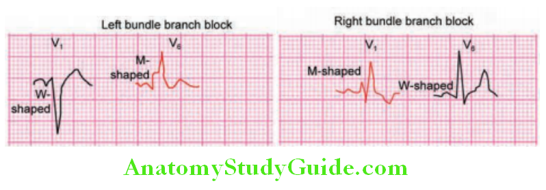 Cardiology Left bundle branch block QS or rS complex in V1 W shaped RsR wave in V6 M shaped