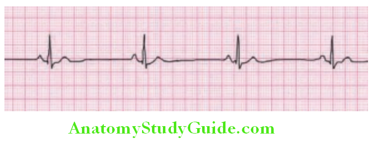 Cardiology Sinus bradycardia Rhythm originates in the sinus node