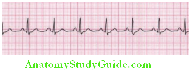 Cardiology Sinus rhythm Cardiac impulse originates from the sinus node
