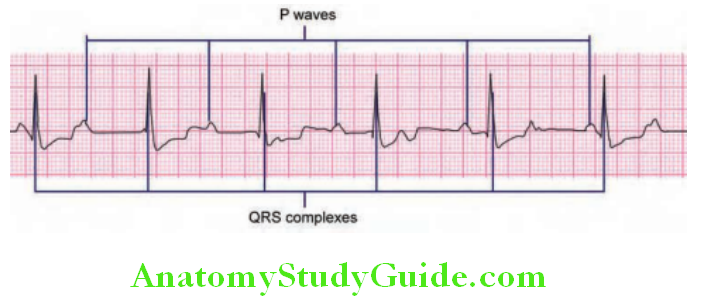Cardiology Third-degree heart block (complete heart block). No relationship between P waves and QRS complexes