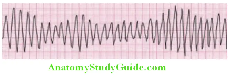 Cardiology Torsades de pointes literally means twisting of points is a distinctive