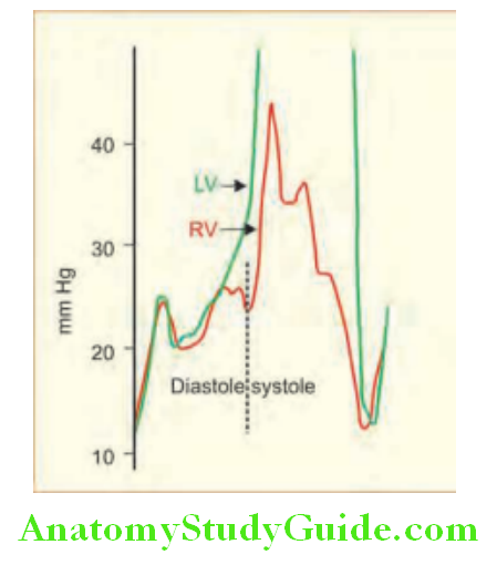 Cardiology Ventricular pressure curve in constrictive pericarditis