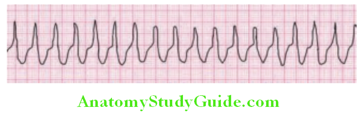 Cardiology Ventricular tachycardia Rate 100–250 beats minute broad QRS regular