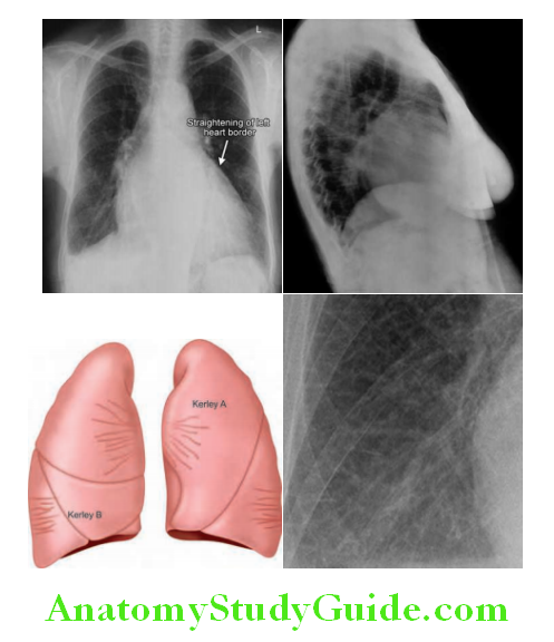 Cardiology X-rays of mitral stenosis showing double atrial shadow and straightening of left heart border