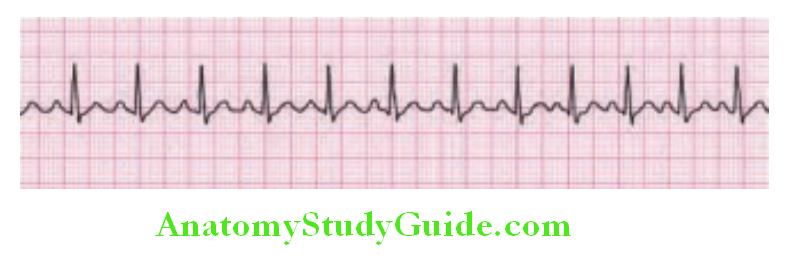 Cardiology sinus tachycardia