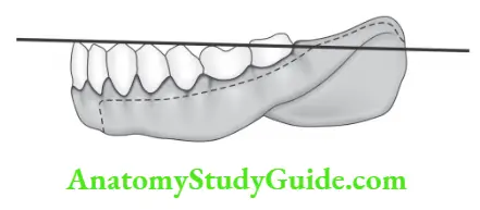 Complete dentures Compensatory curve of lower posterior teeth in relation to a straight line