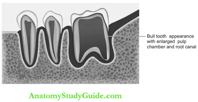 Dental Anomalies Dental Caries Pulp Periapical And Periodontal Lesions Bull Tooth Appearance With Enlarged Pulp Cavity