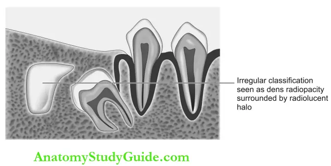 Dental Anomalies Dental Caries Pulp Periapical And Periodontal Lesions Complex Composite Odantome