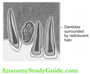 Dental Anomalies Dental Caries Pulp Periapical And Periodontal Lesions Compound Composite Odontome