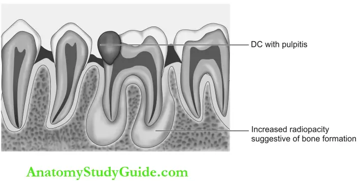 Dental Anomalies Dental Caries Pulp Periapical And Periodontal Lesions Condensing Osteits