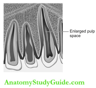 Dental Anomalies Dental Caries Pulp Periapical And Periodontal Lesions Internal Resorption Evident As Round And Ovoid Radiolucencies