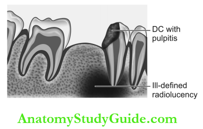 Dental Anomalies Dental Caries Pulp Periapical And Periodontal Lesions Periapical Abscess