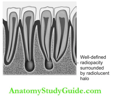 Dental Anomalies Dental Caries Pulp Periapical And Periodontal Lesions Periapical Cementosseous Dysplasia