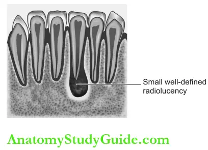 Dental Anomalies Dental Caries Pulp Periapical And Periodontal Lesions Periapical Granuloma