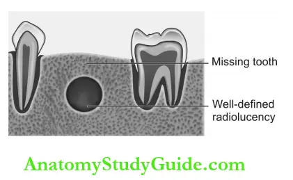 Dental Anomalies Dental Caries Pulp Periapical And Periodontal Lesions Residual Cyst