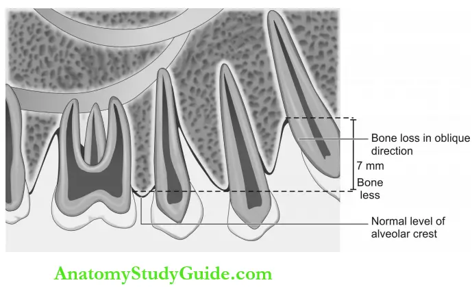 Dental Anomalies Dental Caries Pulp Periapical And Periodontal Lesions Vertical Bone Loss