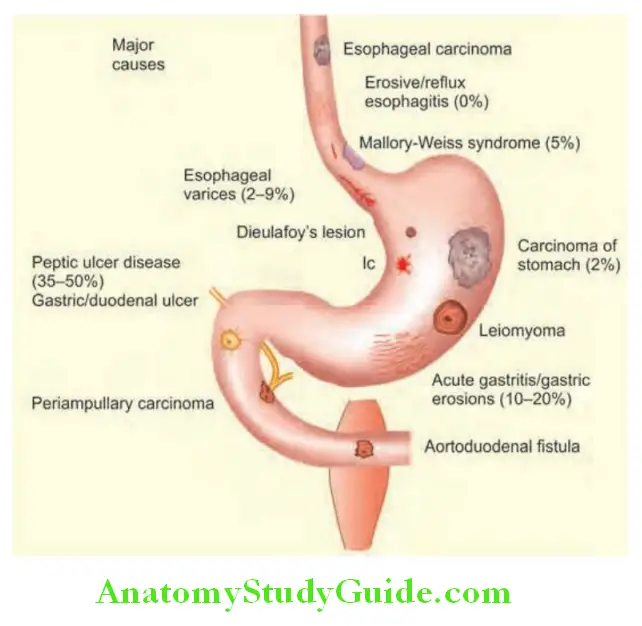 Gastroenterology Causes of acute upper gastrointestinal hemorrhage