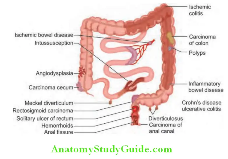 Gastroenterology Causes of lower gastrointestinal bleed