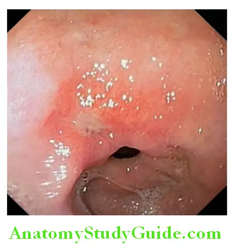 Gastroenterology Endoscopic picture of a benign gastric ulcer